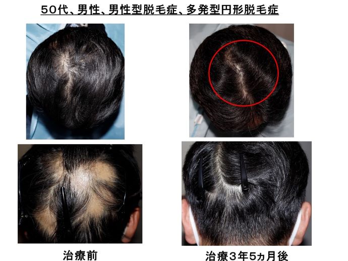 円形脱毛症　病院